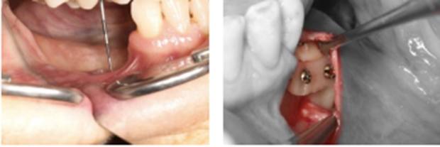 curso-cirugia-reconstructiva-implantologia-aacib curso-cirugia-reconstructiva-implantologia-aacib