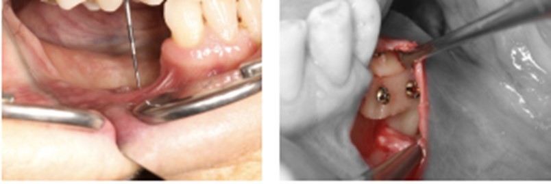 curso-cirugia-reconstructiva-implantologia-aacib curso-cirugia-reconstructiva-implantologia-aacib